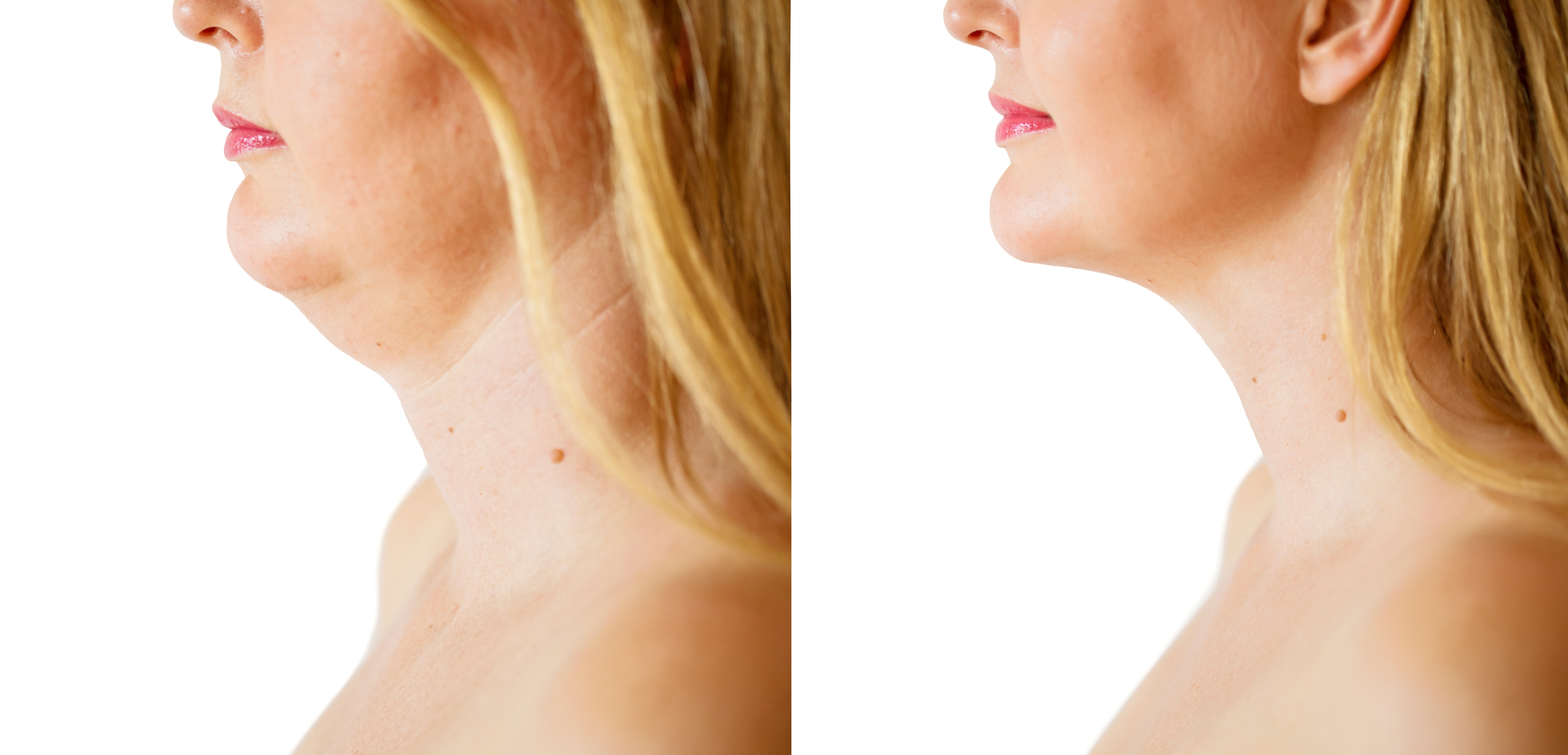liposuctie hals liposuctie hals